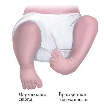 Tratamentul piciorului strâmb fără intervenție chirurgicală